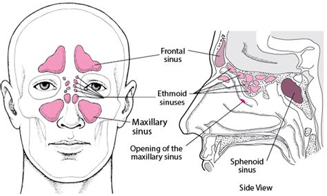 Sinusitis Ear Nose And Throat Disorders Merck Manuals Consumer