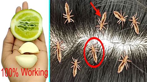 How To Fast Remove Lice From Your Hair Just 2 Daysat Home Youtube
