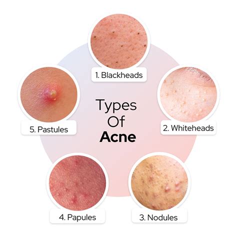 How To Get Rid Of Pimple And Acne Araah Skin Miracle