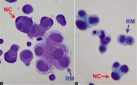 The Panorama Of Different Faces Of Mesothelial Cells Cytojournal