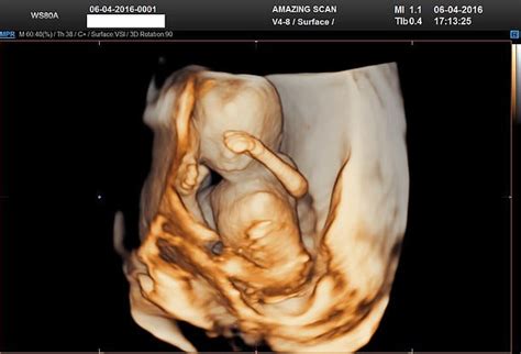 Everything You Want To Know About 3d 4d Ultrasound In Melbourne By