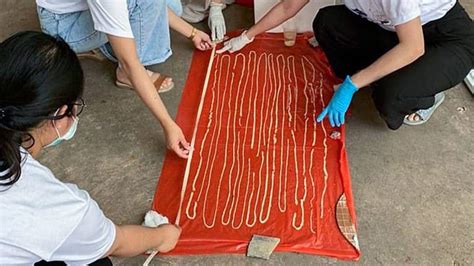 59 Foot Long Tapeworm Discovered Inside Thai Mans Intestines Viral