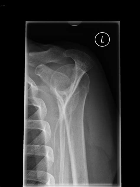 Morphologie des akromions (typ 3 nach bigliani). Bigliani type 3 acromion | Image | Radiopaedia.org