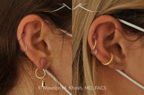 New York Facial Plastic Surgery Keloid Scar Reconstruction Before And