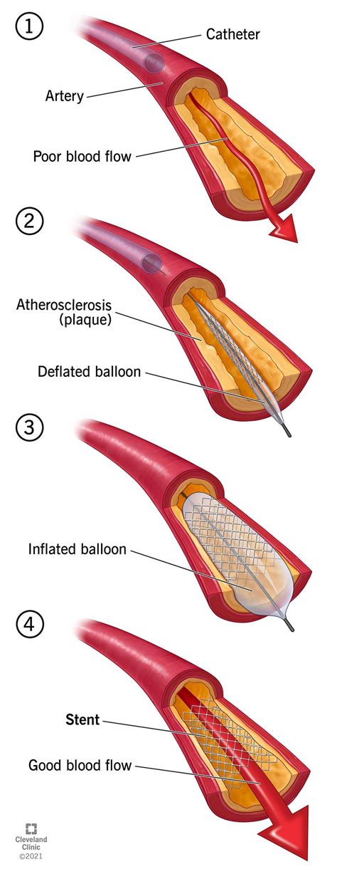 Stent What They Are Purpose And Risks