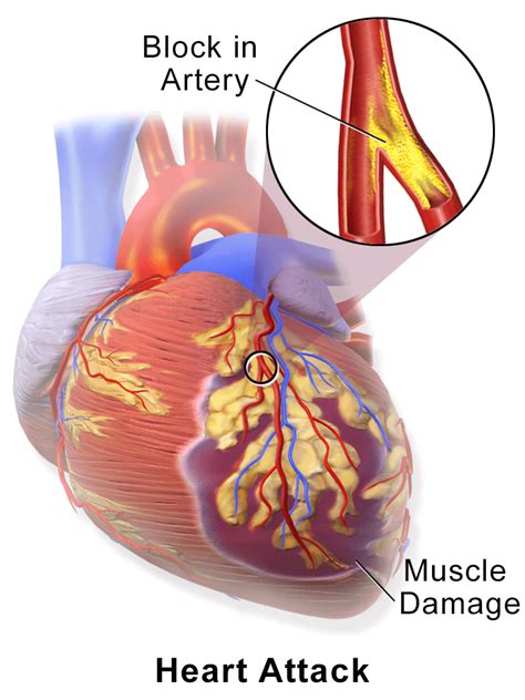 Congestive Heart Failure To Heart Attack Manhattan Cardiology