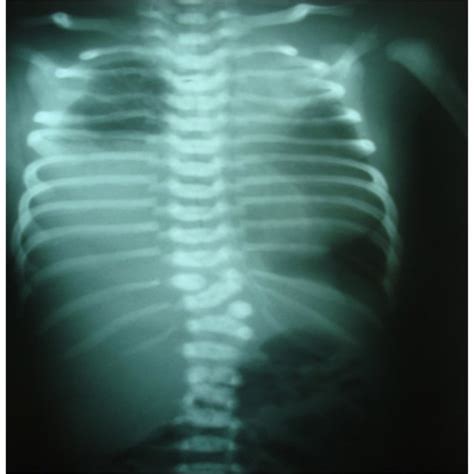 Chest X Ray 10 Days Later Showing Resolution Of Chyle Leak Download
