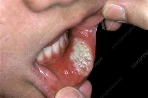 Aphthous Ulcer In The Mouth Stock Image C003 7195 Science Photo