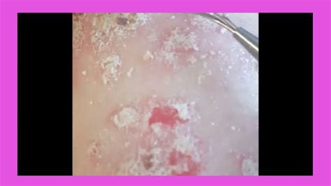Plaque Psoriasis Removal How To Remove Psoriasis Youtube