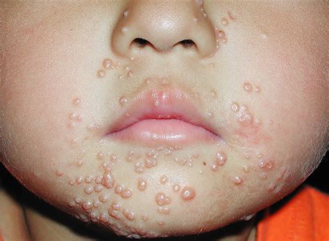Papules On Face