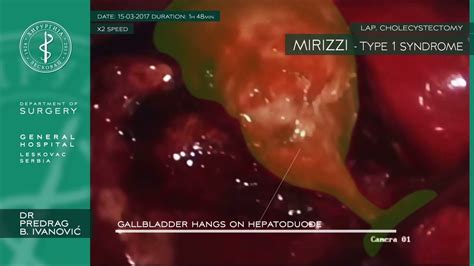 Mirizzi Type Syndrome Lap Cholecystectomy Youtube