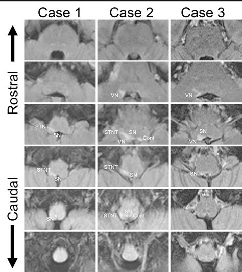 Ramsay Hunt Syndrome Associated With Solitary Nucleus Spinal