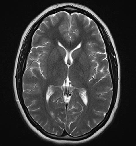 Normal Brain Mri And Venogram Image
