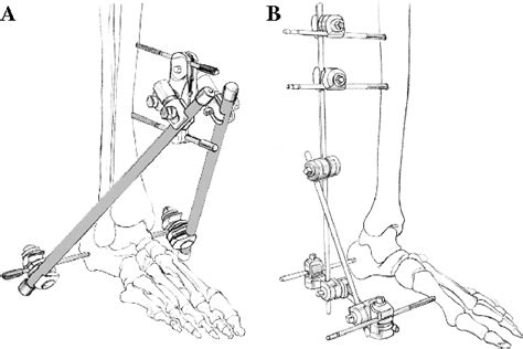 Figure 1 From External Fixation And Temporary Stabilization Of Femoral