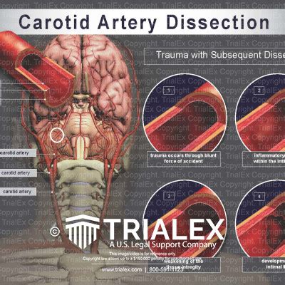 Management Of Dissections Of The Carotid And Vertebral Arteries Sexiz Pix