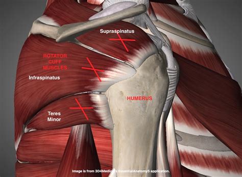 Rotator Cuff Pain Dont Take It Sitting Down Charm