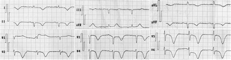 First Electrocardiogram Recorded At The Emergency Room Sinus Rhythm