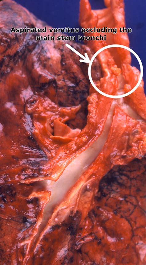 Aspiration pneumonia pathophysiology - wikidoc