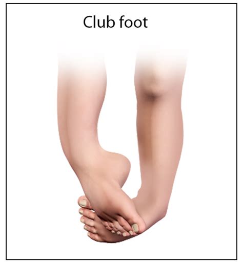 The foot points down and inwards, and the soles of the feet face each other. Club Foot & Congenital Deformity Memphis | Foot Deformity ...