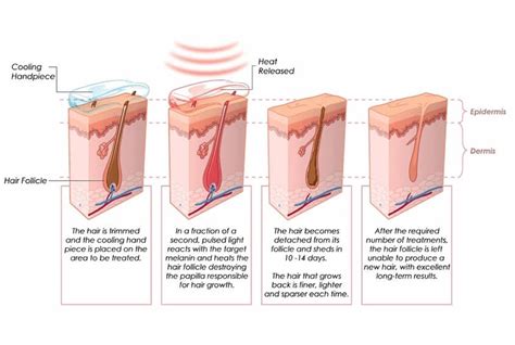 top 48 image how does laser hair removal work vn
