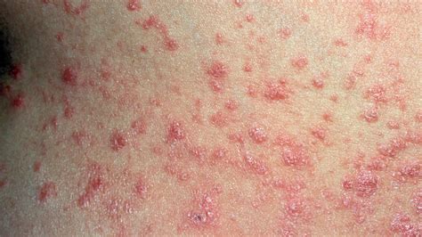 Ibc accounts for 1 to 5 percent of all breast cancers in the united states. Psoriasis Thesis Pictures Rashes ~ Activethroughpassive ...