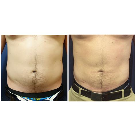 Abdomen Liposuction Before And After Photos