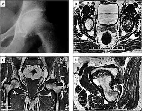 Nilotinib Induced Avascular Necrosis Of Femoral Head In An Adult