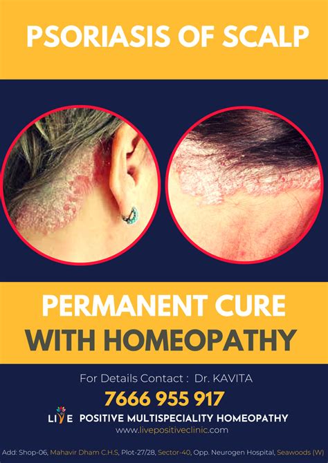 How To Cure Scalp Psoriasis Permanently Rapid Relief