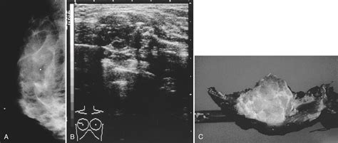 Breast Cancer Metastases Bone Practiceupdate