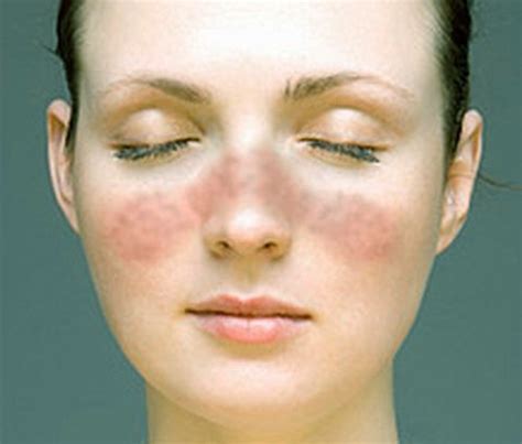 Lupus Face Rash