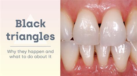 What Causes Black Triangle After Braces Treatment Braces Treatment