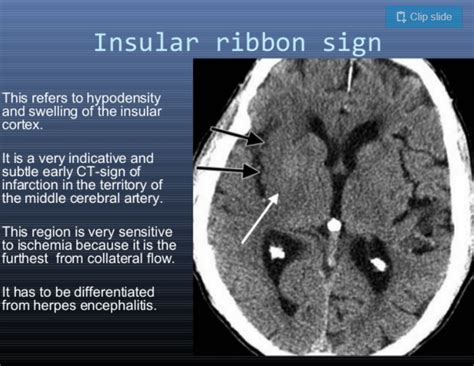 Acute Infarction 6 48 Hrs The Loss Of The Insular Ribbon Sign
