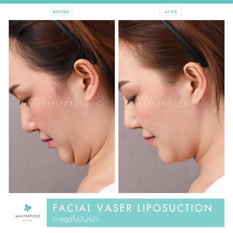 ดูดไขมันหน้า Facial Vaser Liposuction Masterpiece Clinic By Drsae