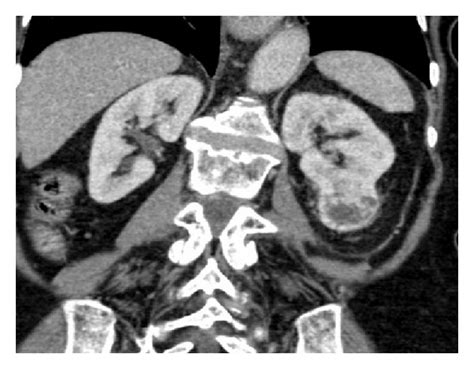 Ct Of Kidneys Coronal Nephrographic Phase Image Demonstrates An