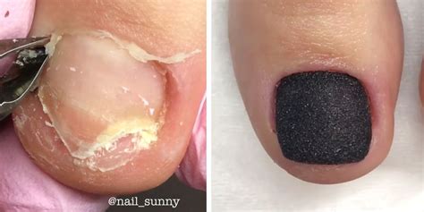 We Cant Stop Watching This Toenail Reconstruction How