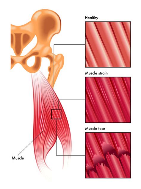 True muscles of the back that lie deep to the thoracolumbar fascia. Pulled Back Muscle: 5 Steps to Quickly Recover