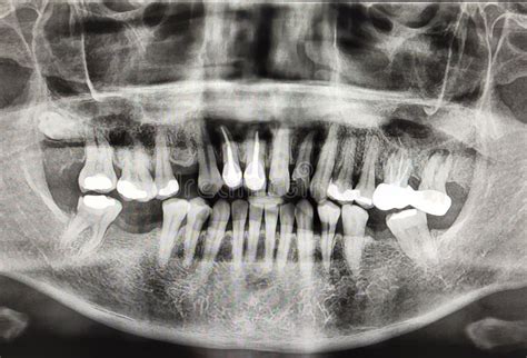 Panoramic Radiograph Skull Full Mouth X Ray Human Disease Oral Surgery