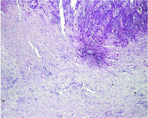Photomicrophotograph Showing Squamous Cell Carcinoma Arising In A
