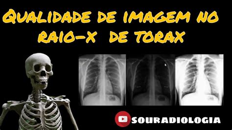 Qualidade Técnica Em Um Raio X De Tórax No Sistema Dr Radiologia Youtube