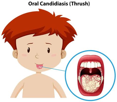 Candidiasis Oral ¿cómo Se Contagia Causas Síntomas Y Tratamientos