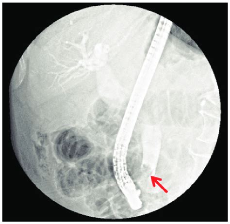 Endoscopic Retrograde Cholangiopancreatography Showing A 1 Cm In