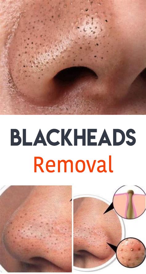 How To Get Rid Of Blackheads Behind Ears Howtorem