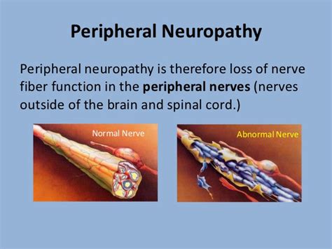 Peripheral Neuropathy Causes Symptoms And Remedies