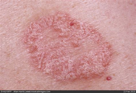 Stock Image Dermatology Moderate Plaque Psoriasis Pink And Dry Oval