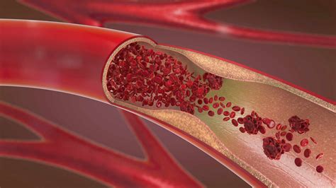 Arteriosclerosis Overview And More