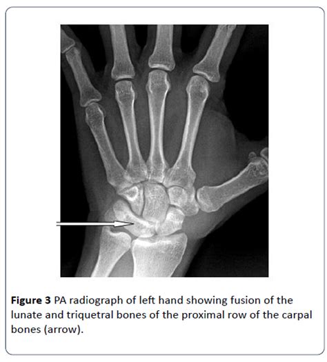 Lunotriquetral Coalition An Infrequent Cause Of Wrist Pain A C