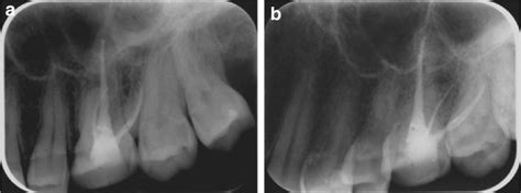 An Upper Molar With A Symptomatic Apical Periodontitis A The