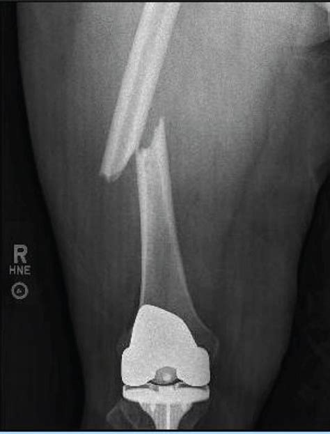 Anteroposterior Radiograph Of The Right Femur Demonstrating A Fracture