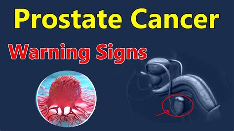 Prostate Cancer Warning Signs Recognizing Early Symptoms Prostatecancer YouTube