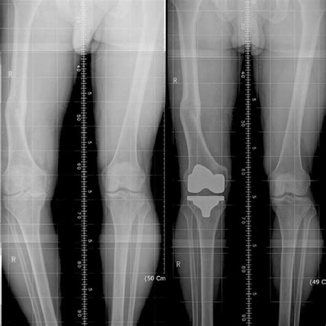 A 60 Year Old Male Patient With Extra Articular Femoral Deformity